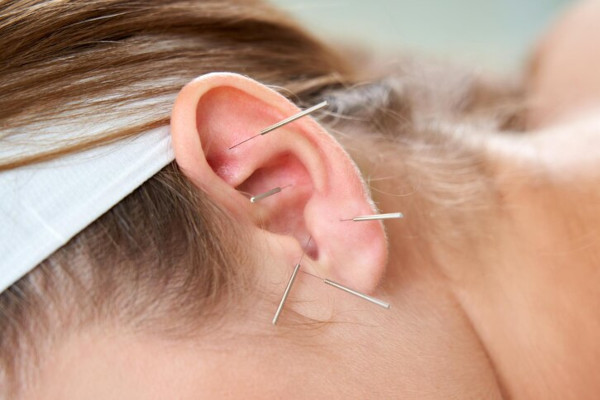 ear acupuncture